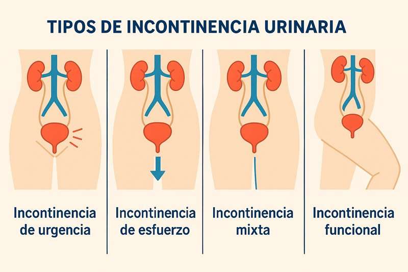 Infografía médica con los tipos de incontinencia urinaria: urgencia, esfuerzo, mixta y funcional